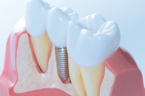 Implante dental unitario